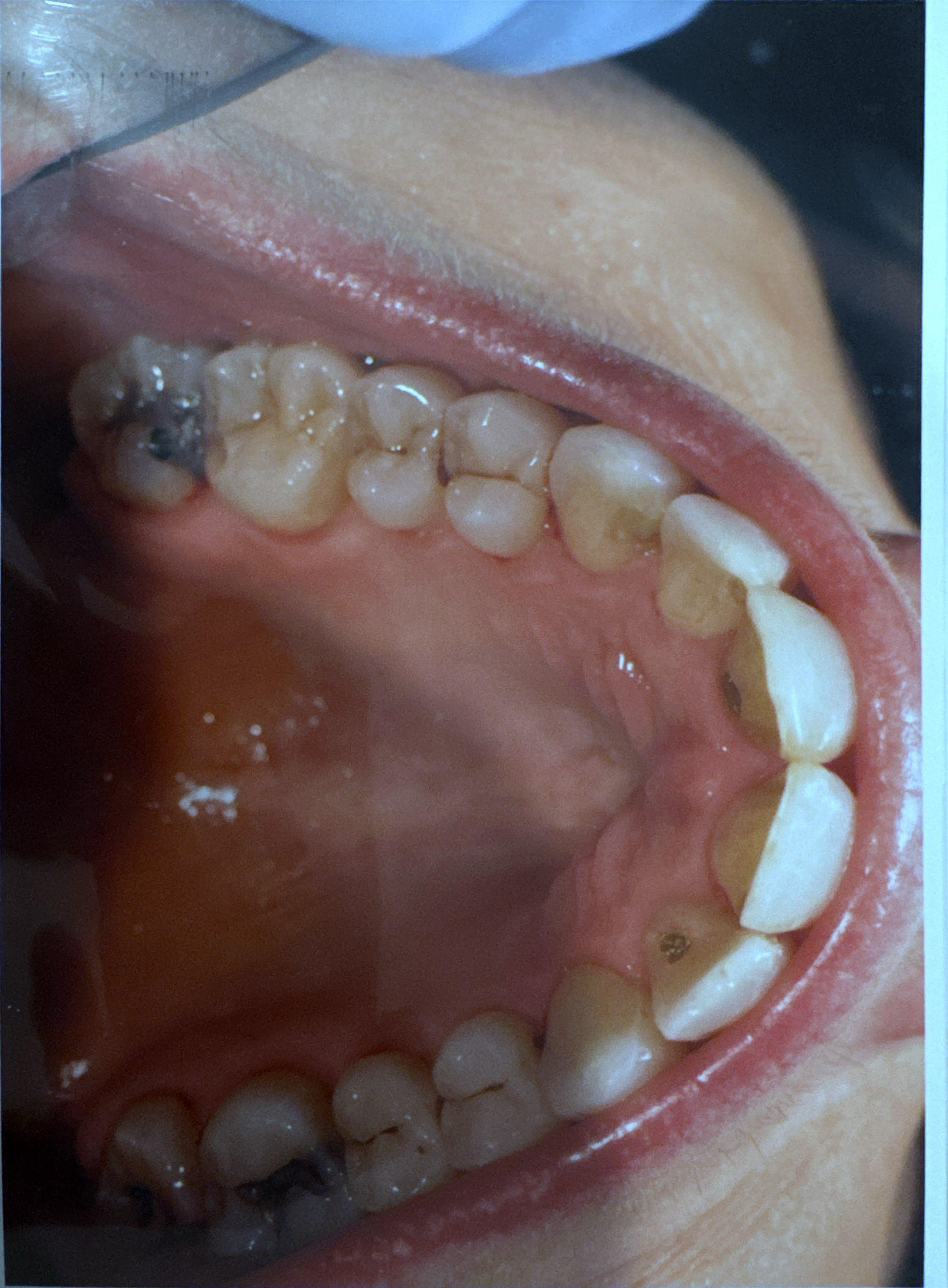 Teeth alignment after Invisalign